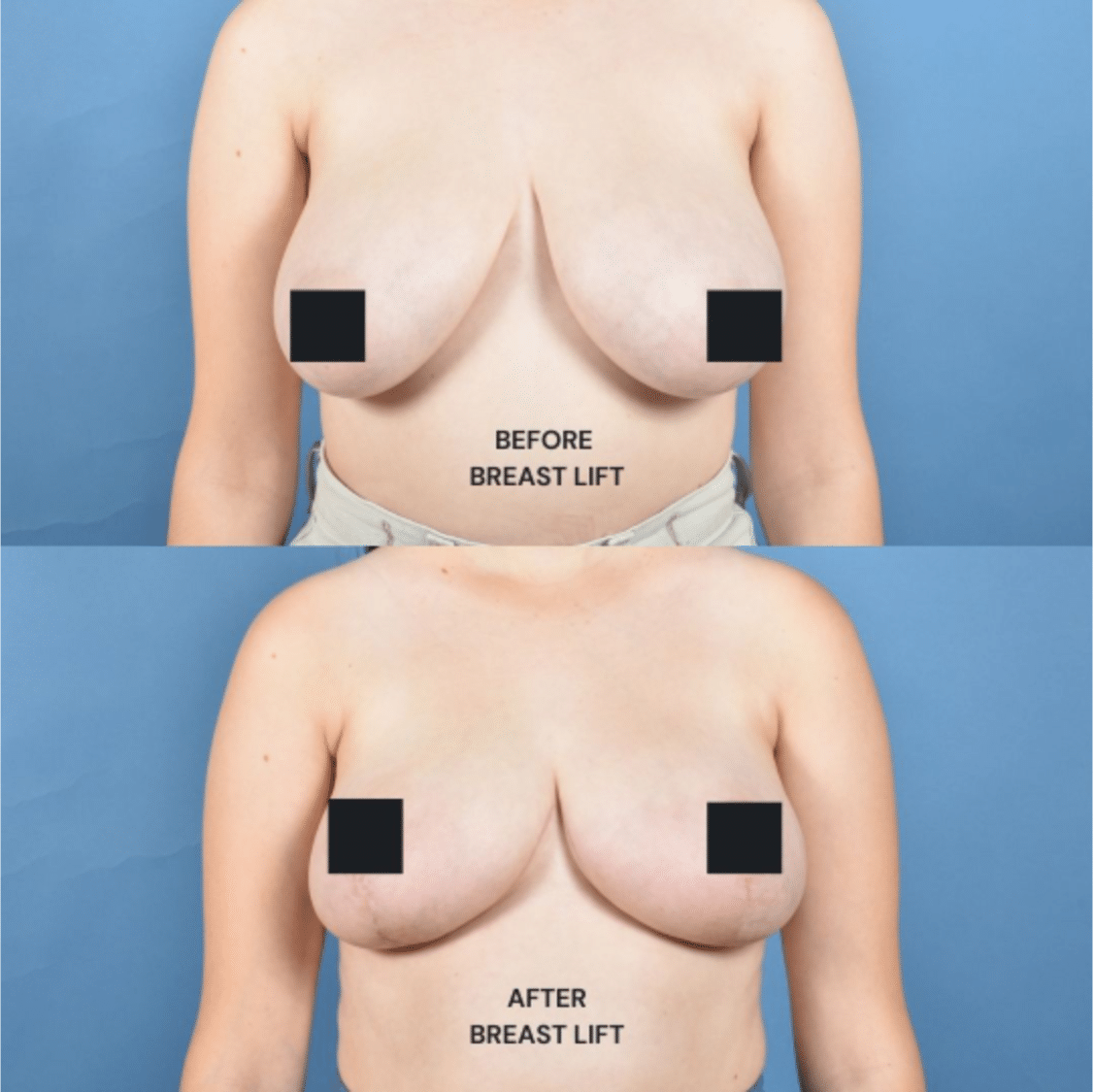Before and After Image: Breast Lift - front