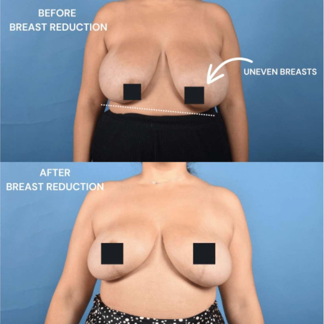 Before and After Image: Breast Reduction - front