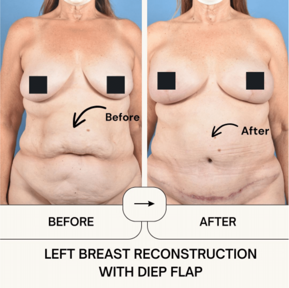Before and After Image: Breast Reconstruction - front