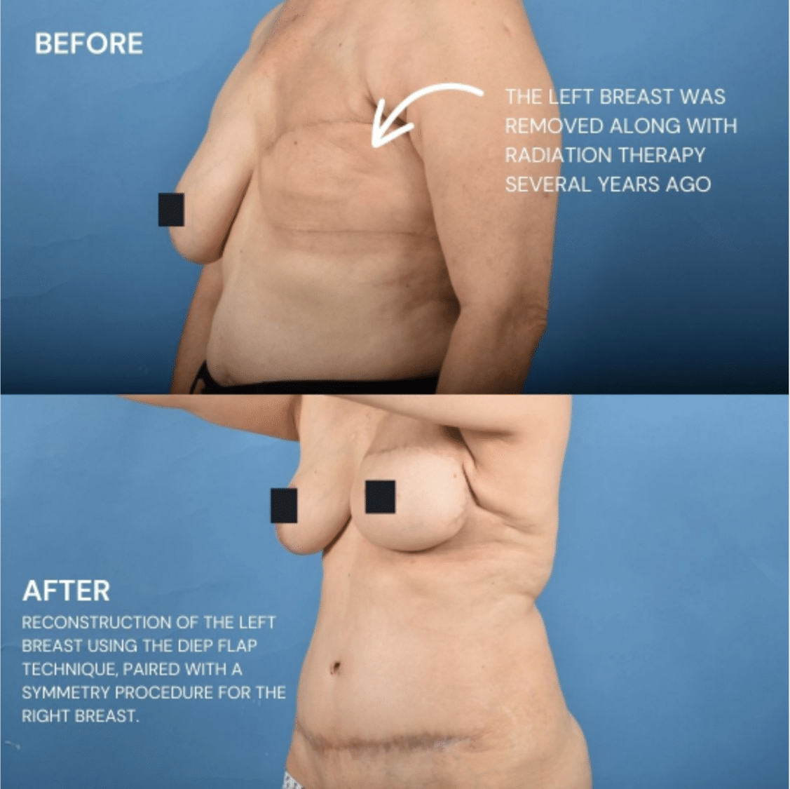 Before and After Image: Breast Reconstruction - left-front-oblique