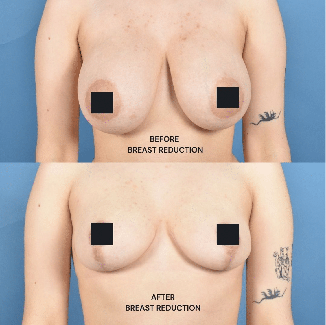 Before and After Image: Breast Reduction - front