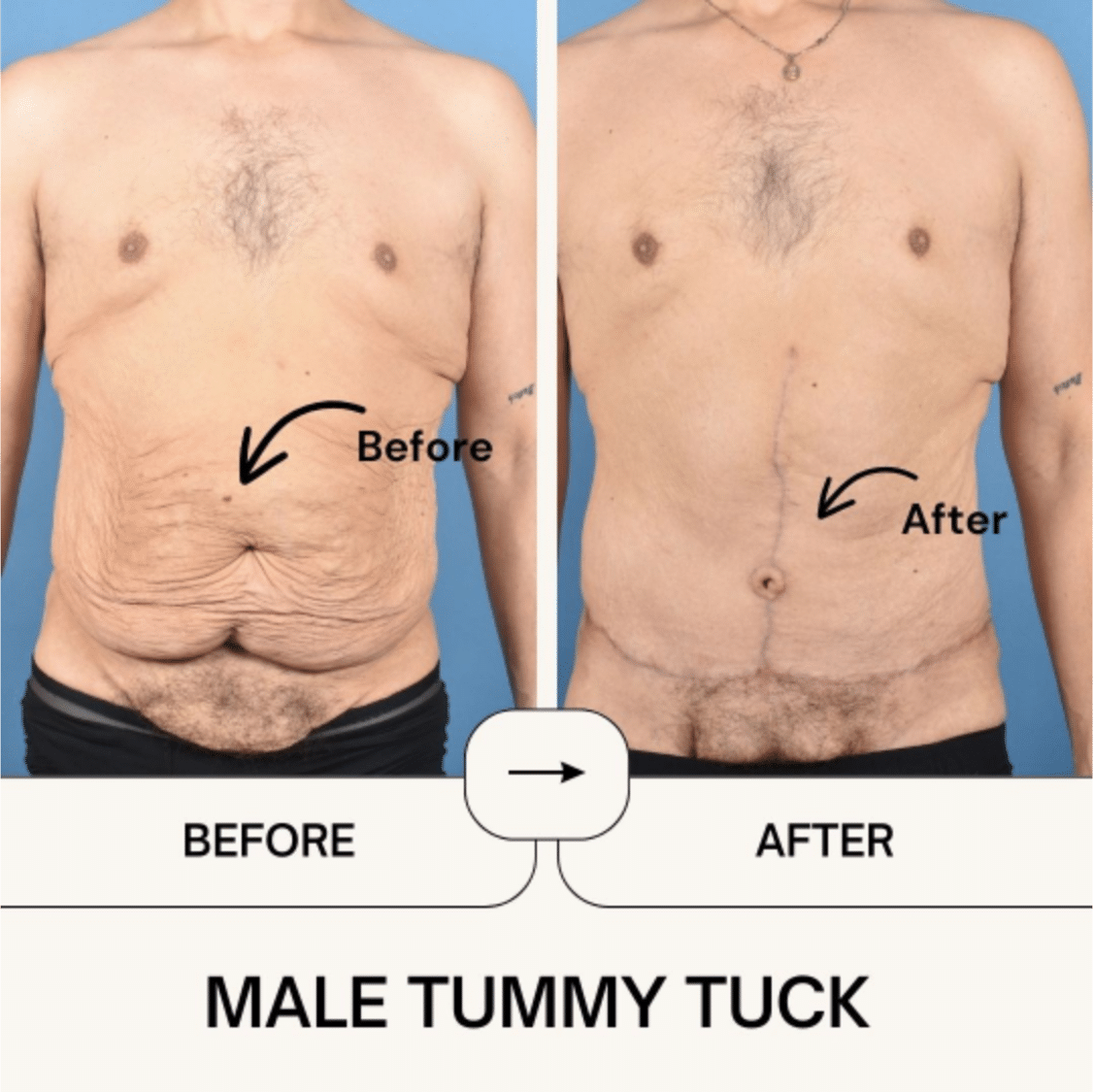 Before and After Image: Male Tummy Tuck - front