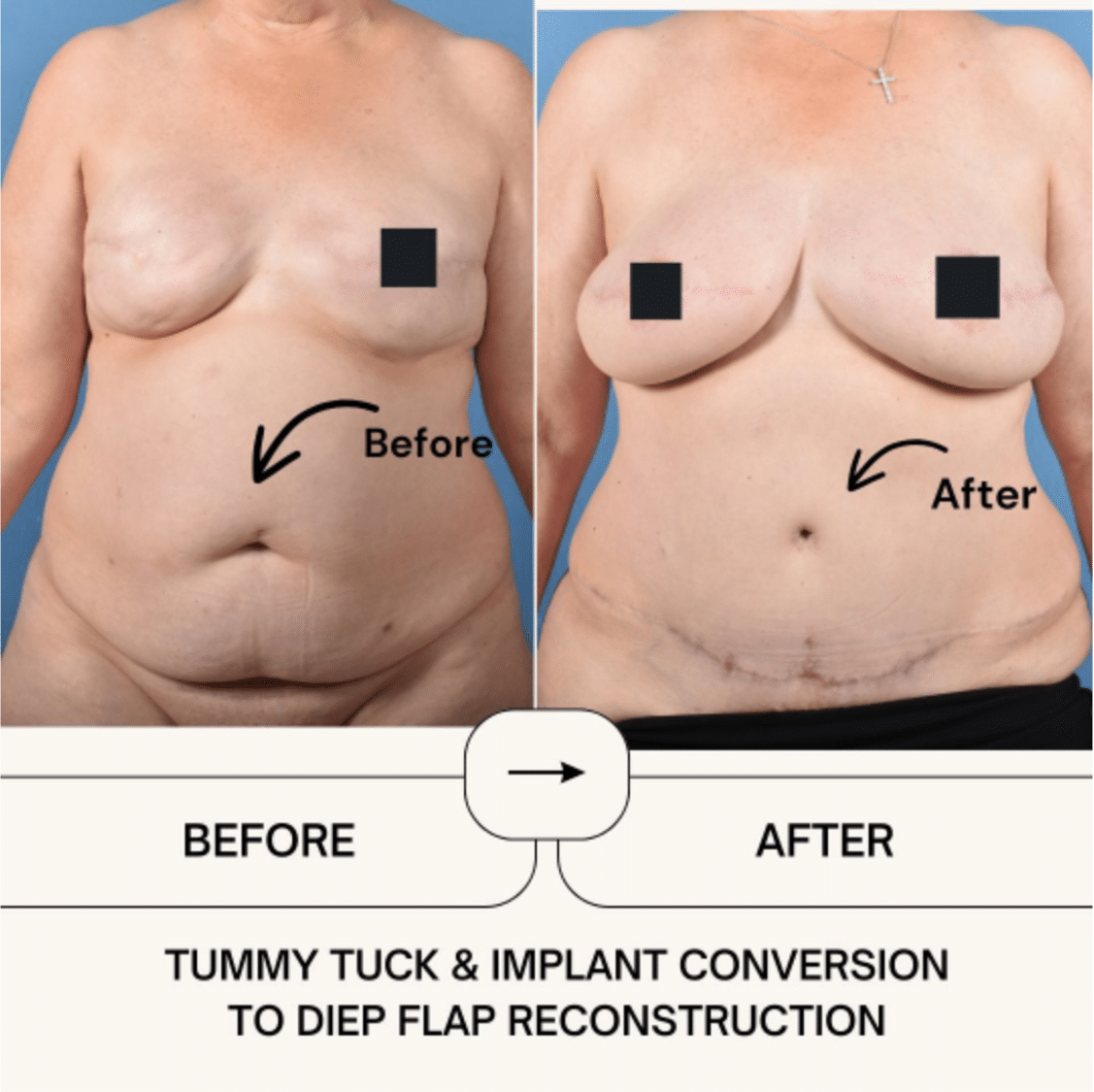 Before and After Image: Tummy Tuck and Implant Conversion to DIEP Flap Reconstruction - front